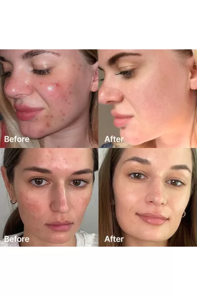  تصویر 2 : سرم سوکسینیک اسید [برطرف کننده جوش] مدی کیوب Medicube 