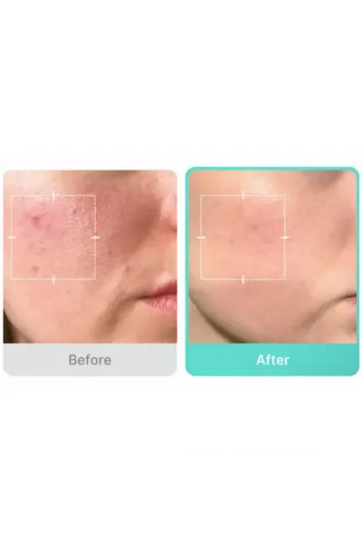  تصویر 1 : سرم آزلايیک اسید ۱۶ درصد مدی کیوب Medicube 