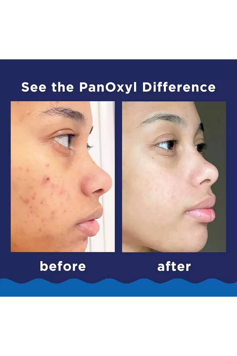 عوامل پایدارکننده فرمول فوم برطرف کننده جوش و آکنه پانوکسیل PanOxyl برای عملکرد مؤثر محصول عوامل پایدارکننده فرمول فوم برطرف کننده جوش و آکنه پانوکسیل PanOxyl برای عملکرد مؤثر محصول