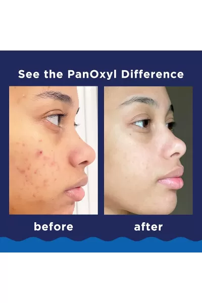 تصویر 4 : فوم برطرف کننده جوش و آکنه پانوکسیل PanOxyl 