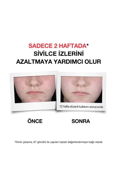  تصویر 5 : سرم ضد جوش پلاس Sivilce Karşıtı نوتروژینا Neutrogena 