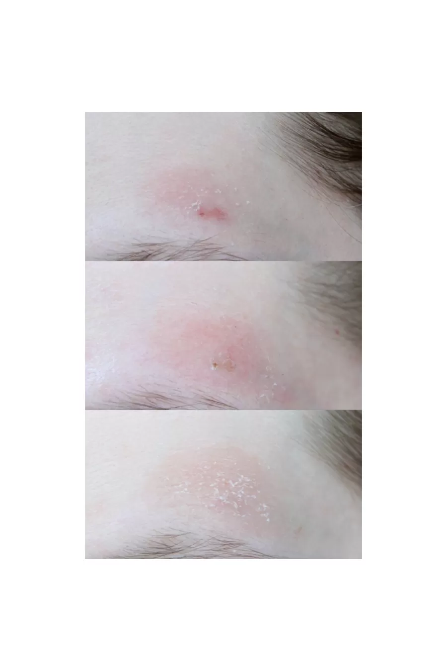 ترفندهای اثرگذاری کرم اورژانسی بر طرف کننده جوش موضعی سنتلا کوزارکس COSRX بر جوشها ترفندهای اثرگذاری کرم اورژانسی بر طرف کننده جوش موضعی سنتلا کوزارکس COSRX بر جوشها