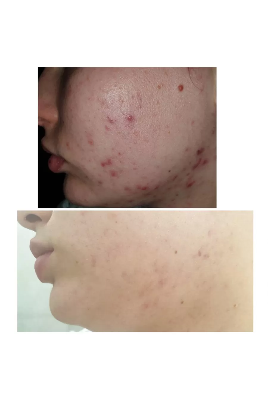 کرم اورژانسی بر طرف کننده جوش موضعی سنتلا کوزارکس COSRX مناسب پوستهای مستعد جوش کرم اورژانسی بر طرف کننده جوش موضعی سنتلا کوزارکس COSRX مناسب پوستهای مستعد جوش