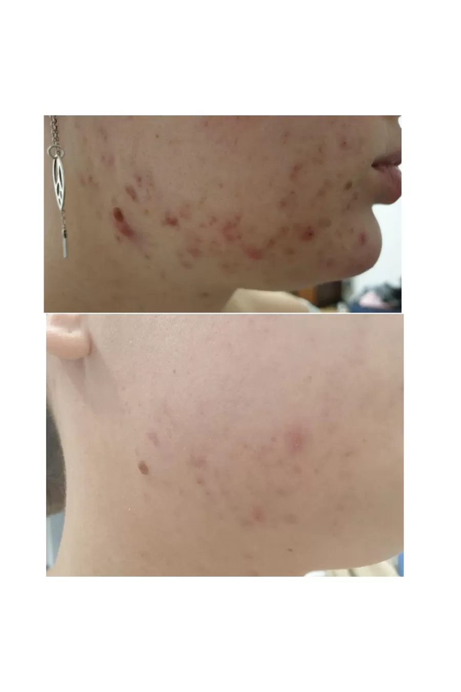 نحوه استفاده از کرم اورژانسی بر طرف کننده جوش موضعی سنتلا کوزارکس COSRX نحوه استفاده از کرم اورژانسی بر طرف کننده جوش موضعی سنتلا کوزارکس COSRX
