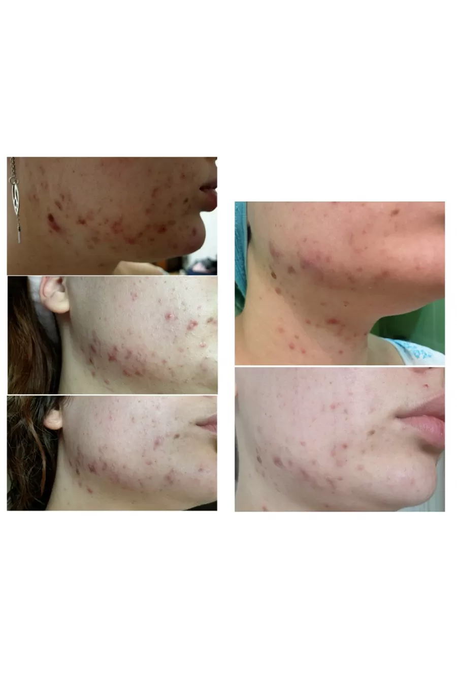 پاسخ به سؤالات متداول درباره کرم اورژانسی بر طرف کننده جوش موضعی سنتلا کوزارکس COSRX