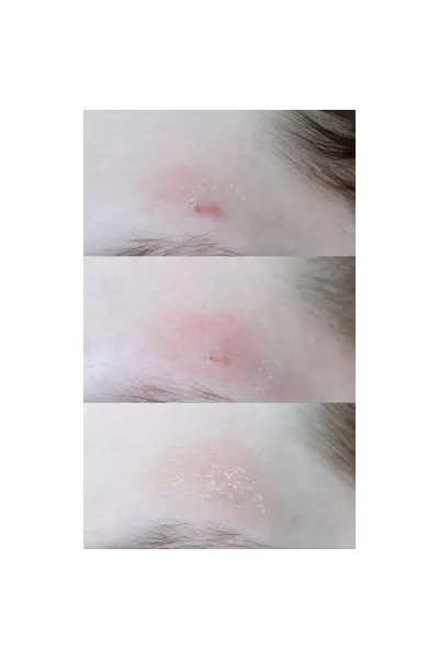  تصویر 4 : COSRX کوزارکس  کرم اورژانسی بر طرف کننده جوش موضعی سنتلا  