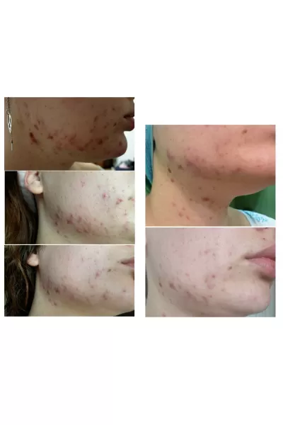  تصویر 7 : COSRX کوزارکس  کرم اورژانسی بر طرف کننده جوش موضعی سنتلا  