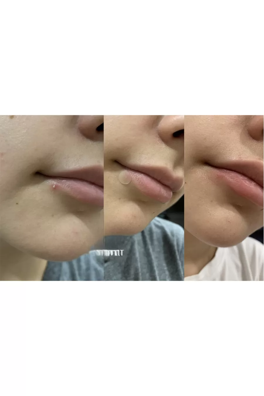 ترفندهای حرفه‌ای برای اثربخشی چسب برطرف کننده جوش‌های ملتهب و چرکی کوزارکس COSRX