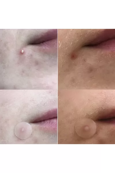  تصویر 2 : COSRX کوزارکس  چسب برطرف کننده جوش‌های ملتهب و چرکی  