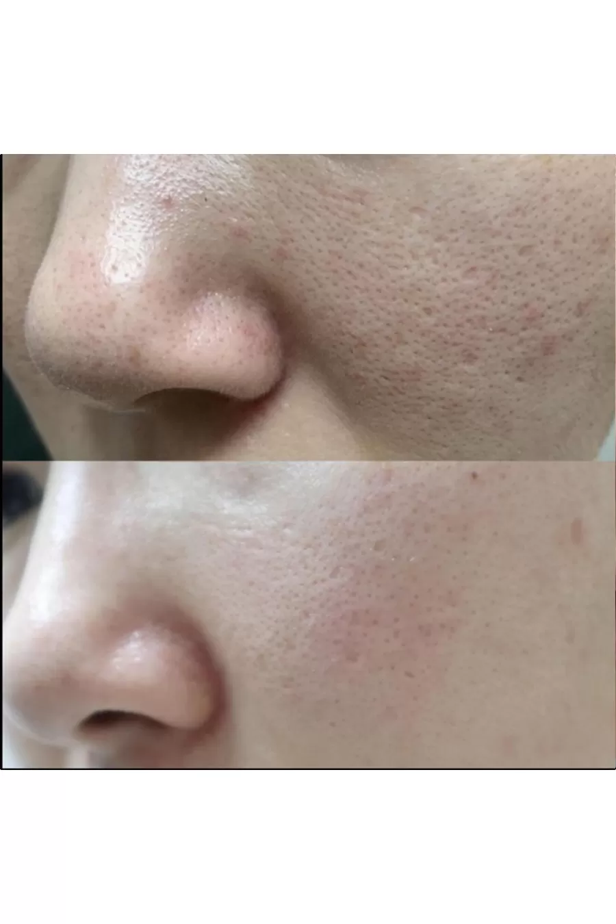سرم اگزوزوم شات کنترل کننده منافذ مدی کیوب Medicube مناسب پوست با منافذ باز و ناهموار سرم اگزوزوم شات کنترل کننده منافذ مدی کیوب Medicube مناسب پوست با منافذ باز و ناهموار