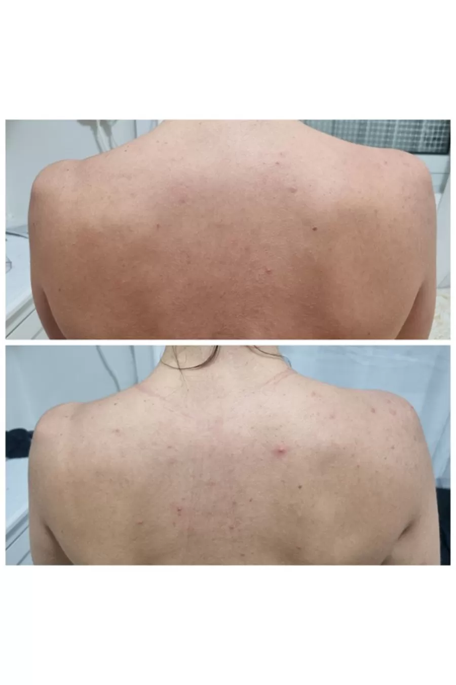 نکات طلایی مصرف شوینده بدن برطرف کننده جوش سام بای می SOME BY MI برای نتیجه بهتر